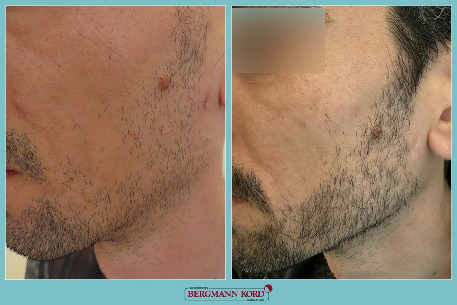 FUE Hair Transplant Case #69432PG