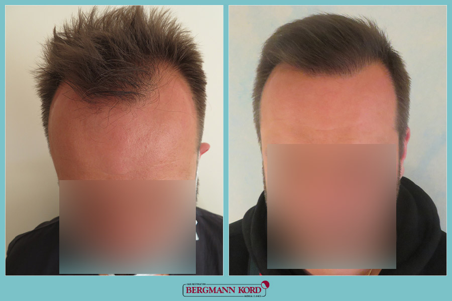 FUE Hair Transplant Case #80357PG