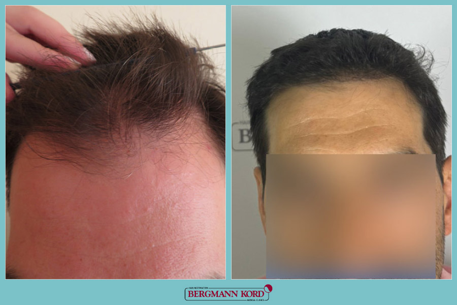FUE Hair Transplant Case #20387PG
